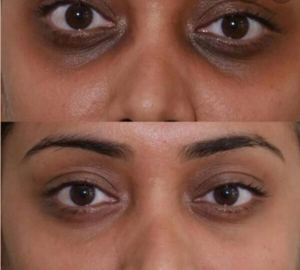 Prp dark circles