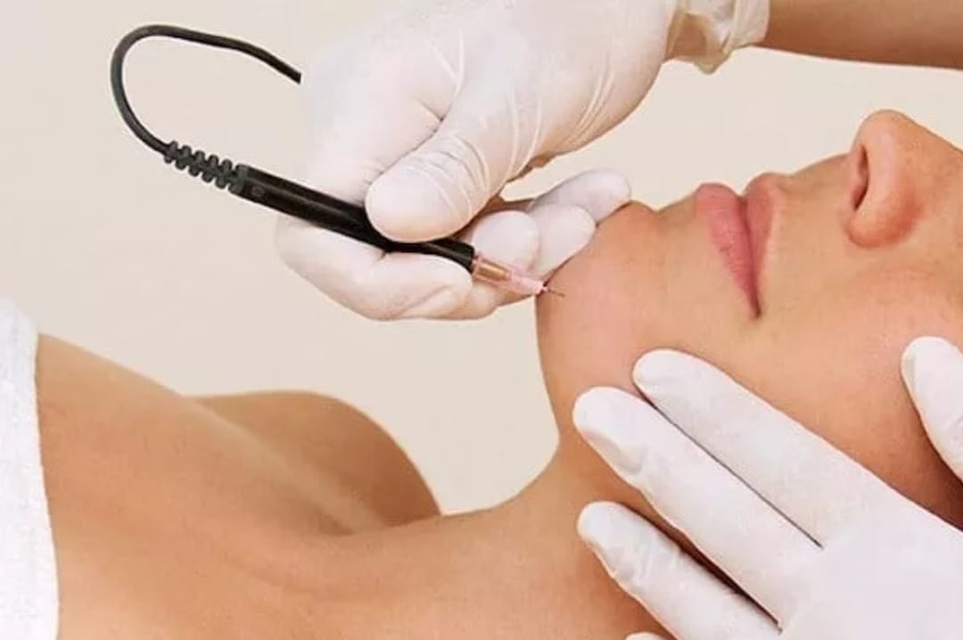 Electrolysis hair removal